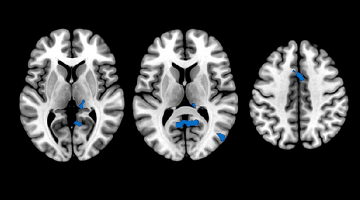 Encuentran cambios en la estructura cerebral y la cognición en personas con insomnio