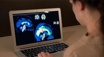 Investigadors europeus milloren la sensibilitat del diagnòstic de les fases inicials de l'Alzheimer