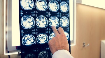 El 94% de los españoles querría saber si se encuentra en fase precoz de Alzheimer