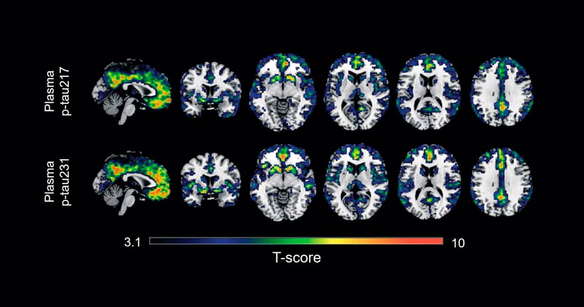 Un nuevo estudio determina dos biomarcadores en sangre que captan mejor los primeros indicios del Alzheimer