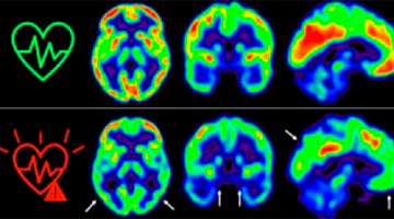 Una investigación demuestra que es beneficioso para nuestro cerebro controlar los factores de riesgo cardiovascular cuanto antes